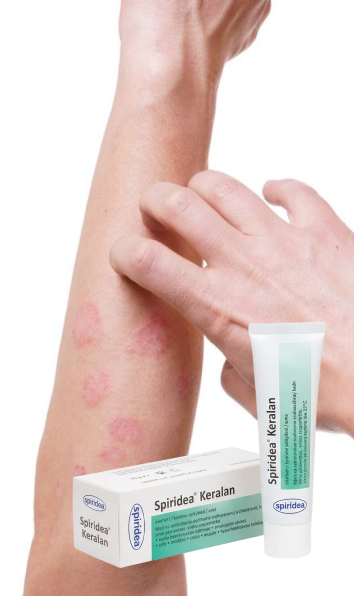 Dermatită atopică