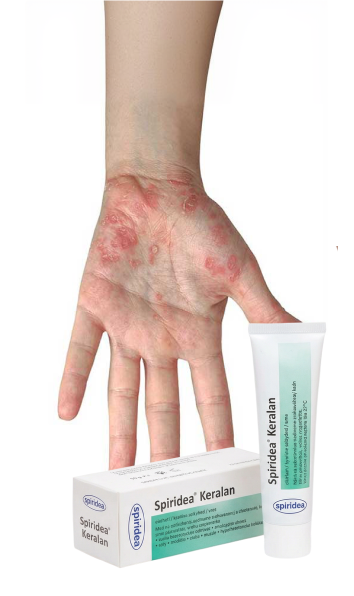 Psoriazis