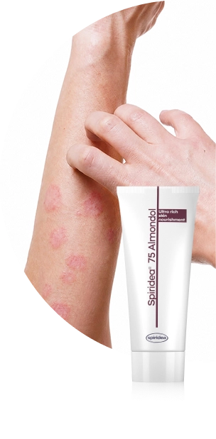 Dermatită atopică