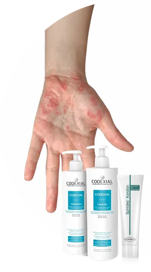 Psoriazis